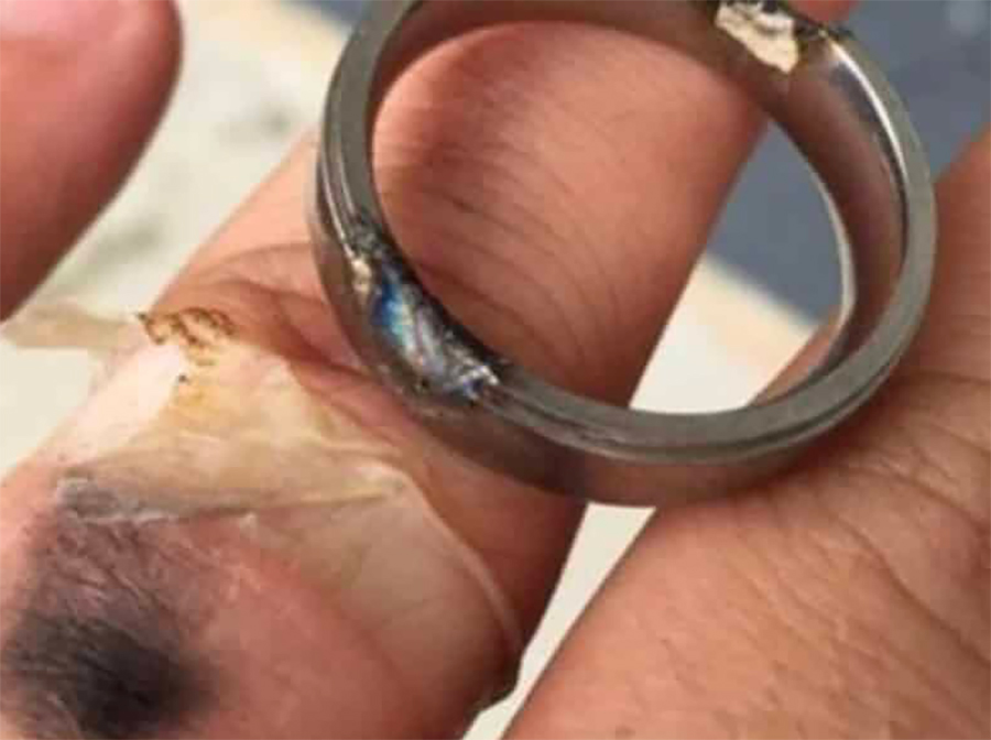 A man's finger burned all the way around by a current that ran through his wedding band